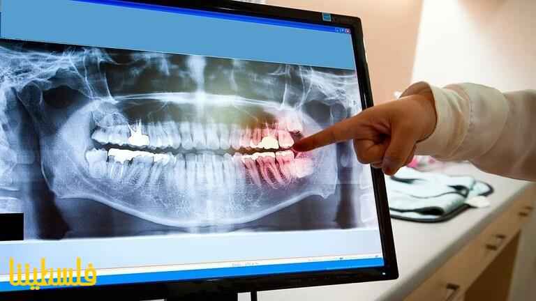 العلماء الأمريكيون يطورون شبكة عصبية قادرة على اكتشاف تسوس الأسنان