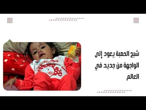 شبح الحصبة يعود إلى الواجهة من جديد في العالم